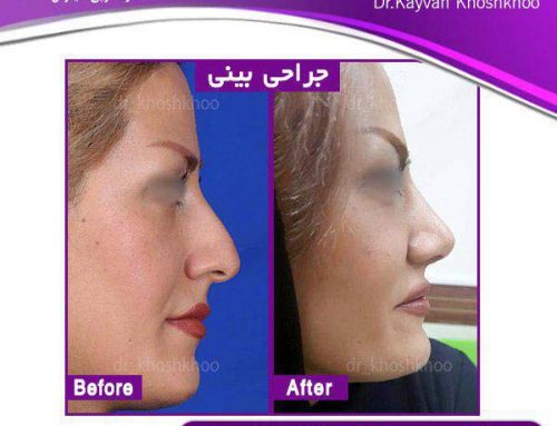 جراحی بینی