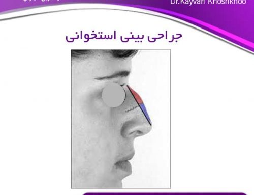 جراحی بینی استخوانی در تهران