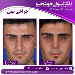 جراحی بینی در مردان - دکتر خوشخو