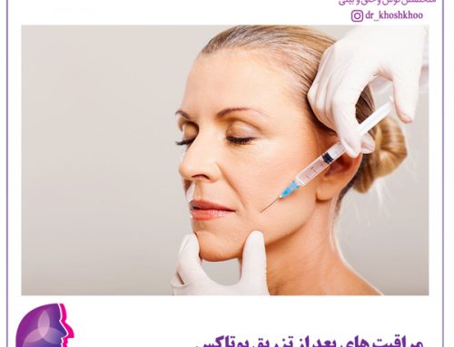مراقبت های بعد از تزریق بوتاکس