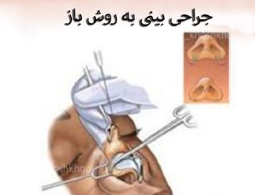 جراحی بینی به روش باز