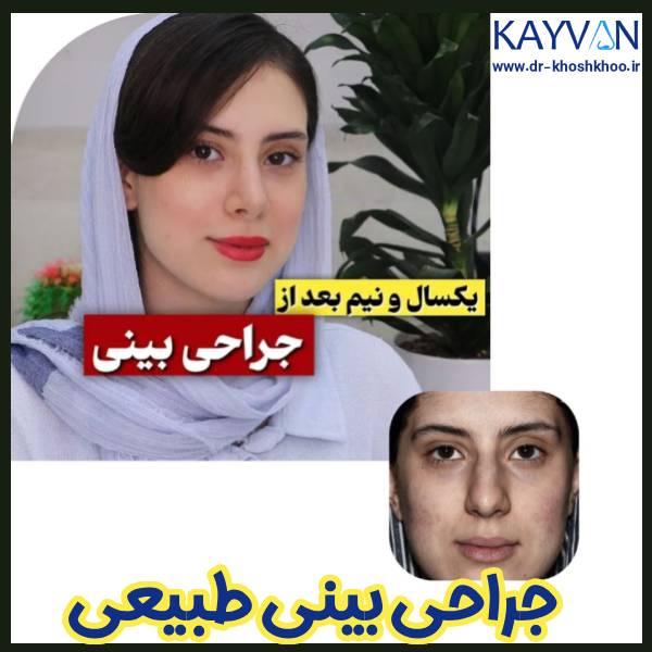 عکس قبل و بعد جراحی بینی طبیعی - دکتر کیوان خوشخو