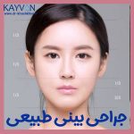 جراحی بینی طبیعی + عکس قبل و بعد عمل