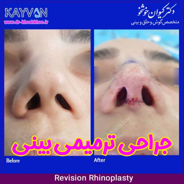 جراحی بینی ترمیمی - دکتر کیوان خوشخو