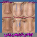 جراحی بینی ترمیمی + عکس قبل و بعد عمل