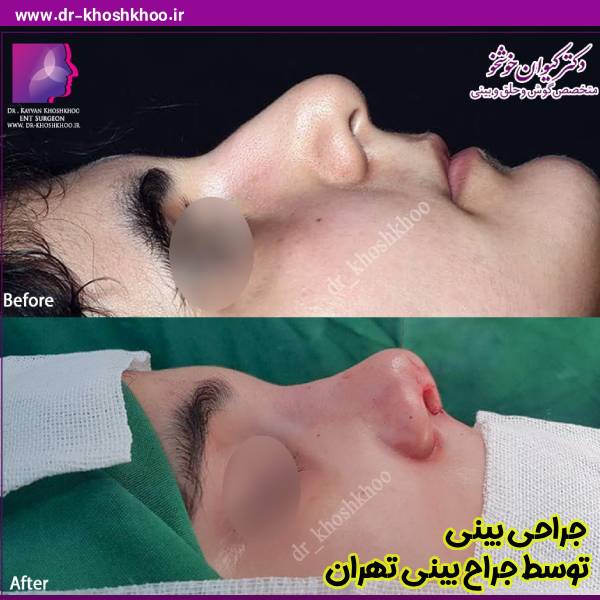 عکس قبل و بعد جراحی بینی - جراح بینی تهران - دکتر کیوان خوشخو