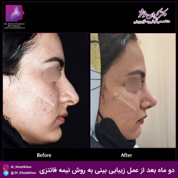 عکس قبل و بعد جراحی بینی نیمه فانتزی - دکتر کیوان خوشخو