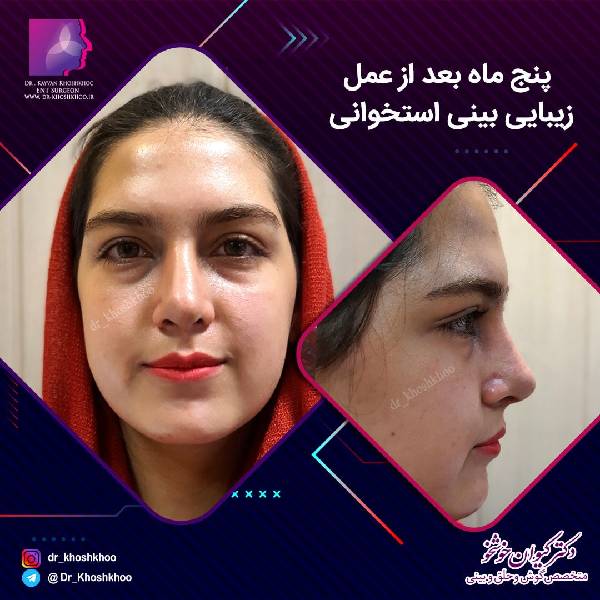 عکس جراحی بینی استخوانی - دکتر کیوان خوشخو