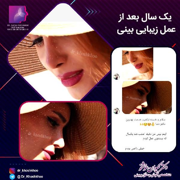 جراحی بینی - دکتر کیوان خوشخو