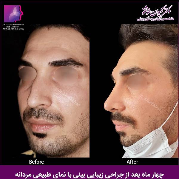 جراحی بینی مردانه - دکتر کیوان خوشخو